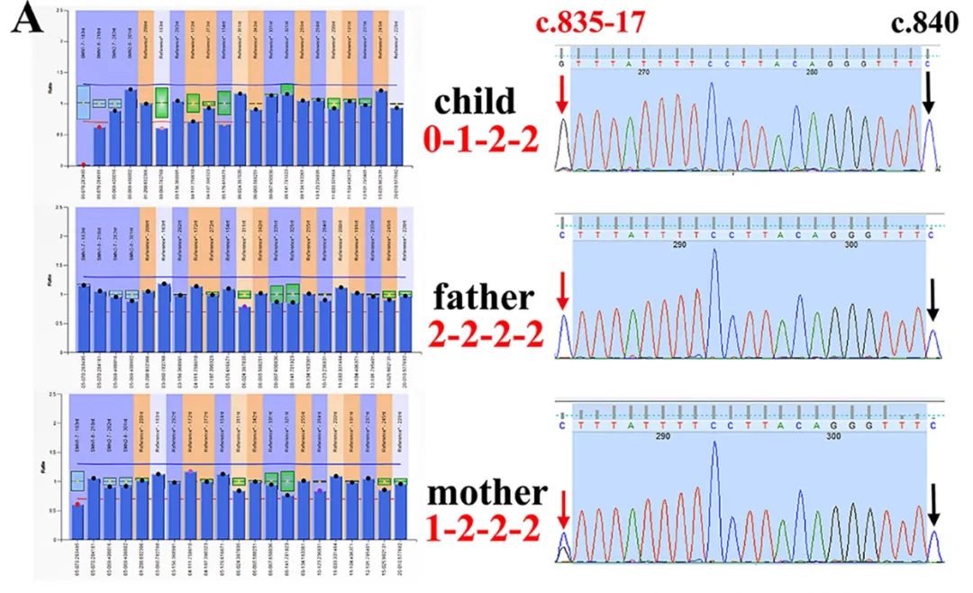 Literature Interpretation: Genetic Characteristics of Chinese Spinal Muscular Atrophy (SMA) Families and Whole Exome Sequencing