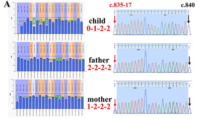 Literature Interpretation: Genetic Characteristics of Chinese Spinal Muscular Atrophy (SMA) Families and Whole Exome Sequencing