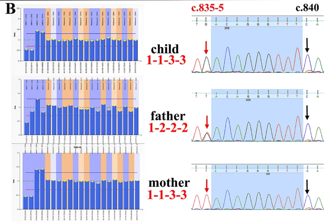 Literature Interpretation: Genetic Characteristics of Chinese Spinal Muscular Atrophy (SMA) Families and Whole Exome Sequencing Literature Interpretation: Genetic Characteristics of Chinese Spinal Muscular Atrophy (SMA) Families and Whole Exome Sequencing